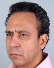 After Hair Transplant&nbsp;Front